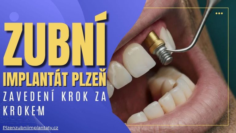 Zubní implantát Plzeň: Zavedení krok za krokem