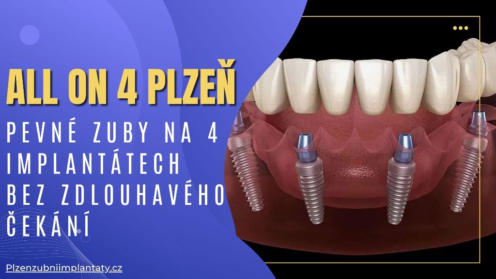 All on 4 Plzeň_ Pevné zuby na 4 implantátech bez zdlouhavého čekání