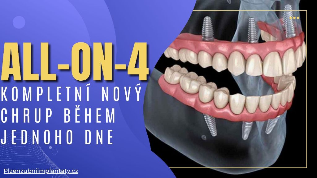 All-on-4_ Kompletní nový chrup během jednoho dne