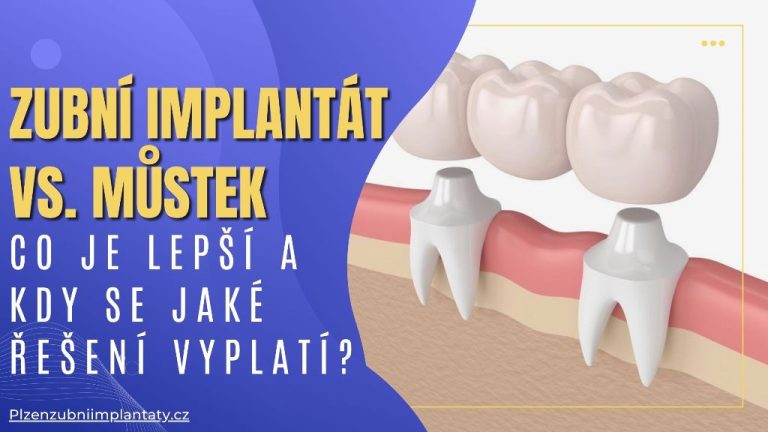 Zubní implantát vs. můstek_ Co je lepší a kdy se jaké řešení vyplatí