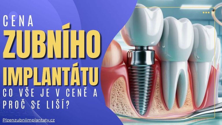 Cena zubního implantátu_ Co vše je v ceně a proč se liší