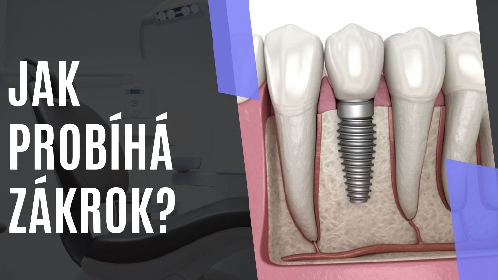 Jak probíhá zákrok