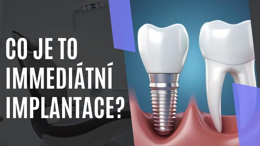 Co je to immediátní implantace